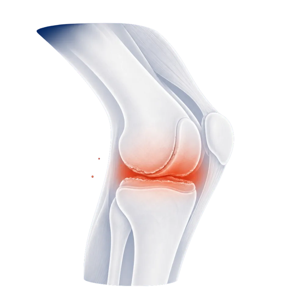 Rodilla con cartílago desgastado e inflamado